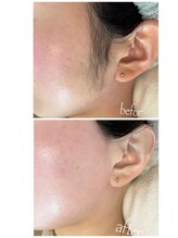 フェイス(Faith)/お顔シュガーリング