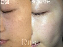 リツ(Ritsu)/シミケア/長年のシミケア