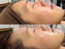 ブラン(BLANC)/【芸能人ピーリング】水光ピール