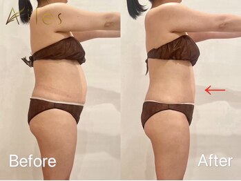 エール 恵比寿店(AILES)/40代ハイボルテージ＋全身リンパ