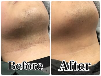 ルリアン(LeLien)/髭脱毛　施術7回の効果！！