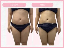 RHB 横浜店/【痩身コース】ビフォーアフター