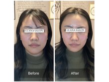 ルアナサロン(LUANA SALON)/美脳小顔毛穴洗浄