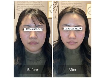 ルアナサロン(LUANA SALON)/美脳小顔毛穴洗浄