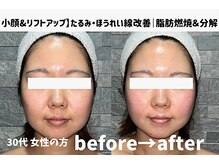 サロンスペース/30代 女性【小顔&リフトアップ】