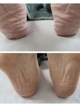 ソラ(sora)/踵ケア☆乾燥☆角質☆フットケア