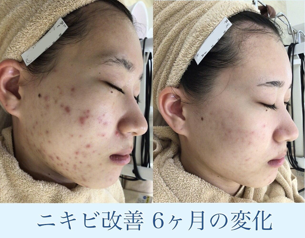 《肌荒れ全般/クーポンに悩まれた方》王道9STEPコースたっぷり120分\5500