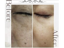 ピュアル 川口(Pual)/【老化肌】Pual症例