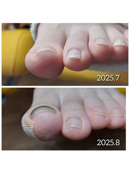 爪切り屋 足楽/爪のリフトアップで痛みを軽減