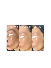 ソリッジ肌管理室/シミケア