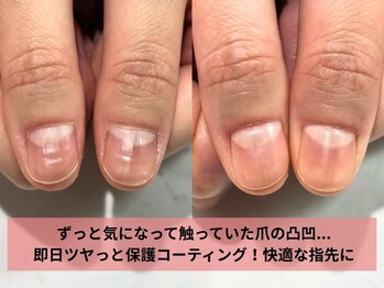 爪の凸凹ができる原因はコレ!