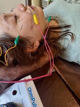 爽健美/電気を流す美容鍼