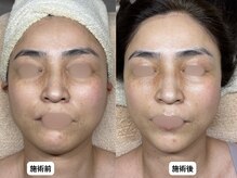 エングラッシー(en glassy)/BEFORE　AFTER　40代