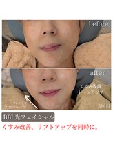 ティンクル サロン(Twinkle salon)/BBL光/フェイスラインすっきり