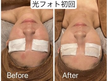 アイラブワン(eye love one)/光フォト【毛穴/美白/艶】