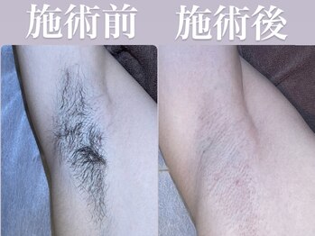 ソーレエルーナ(SOLE e LUNA)/光脱毛 メンズ脱毛