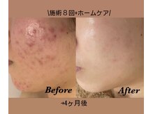 メナードフェイシャルサロン 片町店/早期で綺麗になりたい方必見！