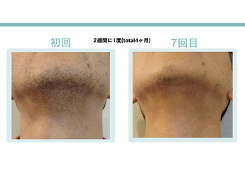 スターポルト(Star-Porte)/ヒゲ脱毛