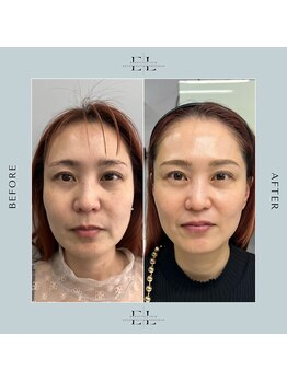 サロン ド ラヴィエール(salon de Laviere)/新メニュー　エクソリフト