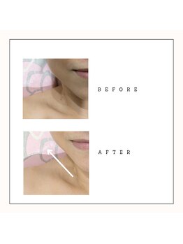 ミヤビ(miyabi)/小顔矯正