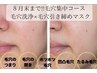 【８月末まで特別価格】毛穴の目立たない肌へ！毛穴洗浄×毛穴引き締めマスク