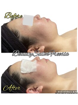 フリージア(Beauty Salon Freesia )/小顔造形×脂肪分解リフト 1回