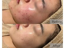 シェリーミル(Cherie Miru)/ニキビ/毛穴/赤ら顔/色むら