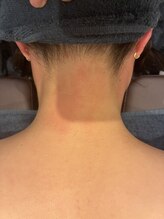 ソイ(soi)/脱毛　after