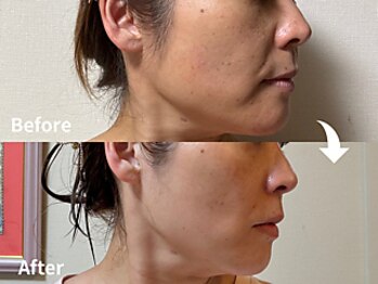 サロンドモモ(SALON de MOMO)/美肌★フェイシャルビフォアフ