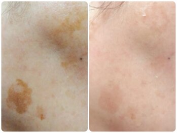 スイ 昭島店(Sui)/ホワイトスノーピール/シミ/美白