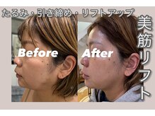ミリュール(Millule)/美筋リフト（EMS×ラジオ波）