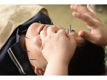 がんばる接骨院の雰囲気(美容鍼は男女に関わらず大人気!)