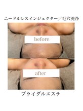 サラ/ニードルレスインジェクター