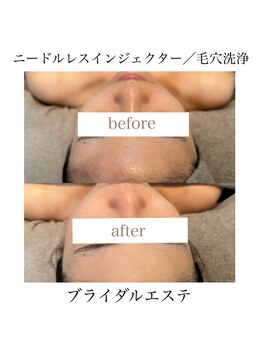 サラ/ニードルレスインジェクター