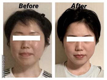 ショウフェイスデザイン(Sho Face Design)/《小顔矯正》ビフォーアフター