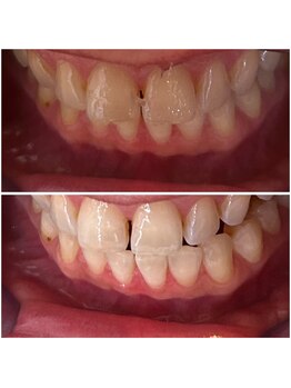 エクシアホワイトニング 代々木店/ホワイトニングビフォーアフター