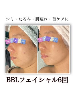 ルアナライフ(Luana Life)/BBLフェイシャル6回 40代