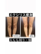 リベル(Liber)/痩身マシンエクシリス【太もも】