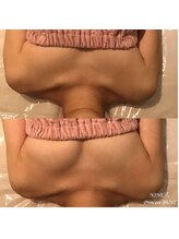 ラウレア(Laule'a)/バストアップ症例