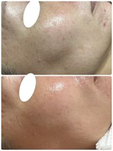 リノ(Lino)/3ヶ月間で3回お手入れ