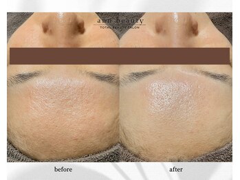 アン ビューティー(ann beauty)/施術1回【症例写真】30代