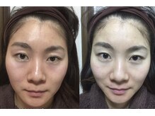 ヴィーナスハンド/ゴットハンドに認められた小顔！