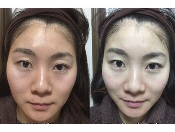 ヴィーナスハンド/ゴットハンドに認められた小顔！