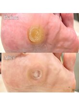 巻き爪補正店 越谷店/タコ・魚の目ケア