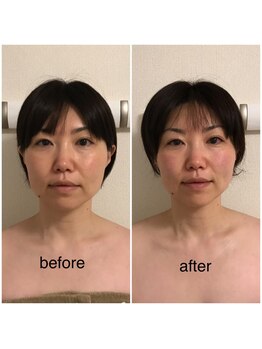 ココ(coco)/小顔モニター様☆