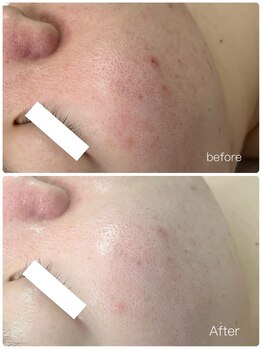 ビビ(Be_bi)/驚きの美白！！