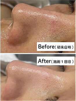 チェリオール(Cherioll)/ハイドロ毛穴洗浄