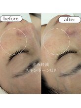 ケアプラス/頬の赤み改善