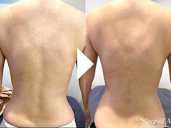 ビースト 下北沢店(B-st.)/痩身｜上半身1回