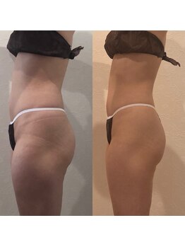 キュール(KuhL)/痩身ビフォーアフター☆